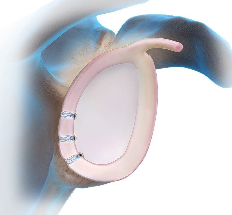 Arthrex - Short 2.9 mm BioComposite PushLock Implant System